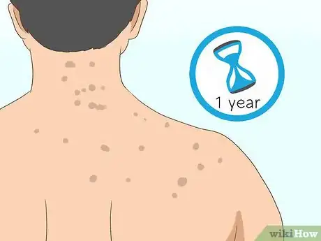 Image intitulée Get Rid of Back Acne Scars Step 1