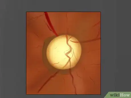 Image intitulée Use an Ophthalmoscope Step 13