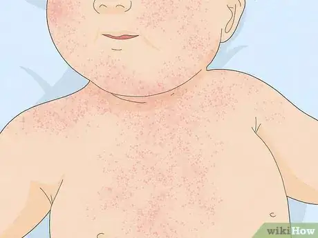 Image intitulée Treat Baby Heat Rash Step 7