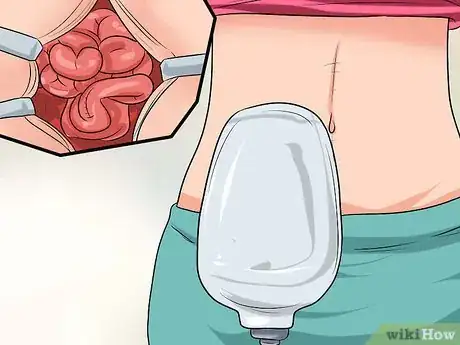 Image intitulée Recognize the Symptoms of Inflammatory Bowel Disease Step 11