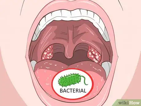 Image intitulée Tell a Viral from a Bacterial Infection Step 3