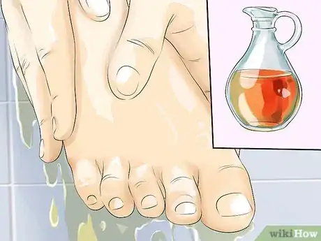 Image intitulée Remove Calluses Naturally Step 5