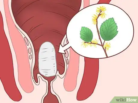 Image intitulée Use Witch Hazel to Reduce Hemorrhoids Step 16