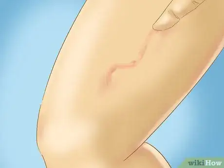 Image intitulée Recognize Hives (Urticaria) Step 5