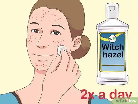 Image intitulée Get Rid of Acne Fast Step 7