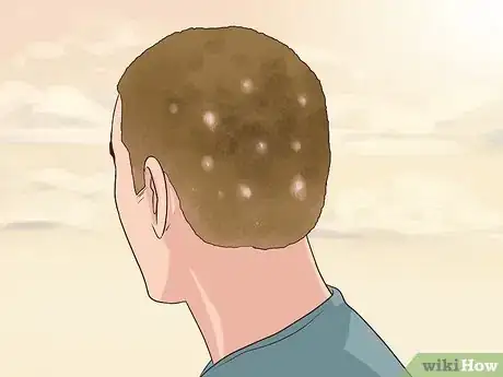 Image intitulée Diagnose Scalp Psoriasis Step 14