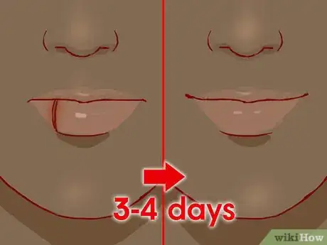 Image intitulée Treat a Cut Lip Step 11