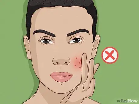 Image intitulée Get Rid of Acne Redness Step 14