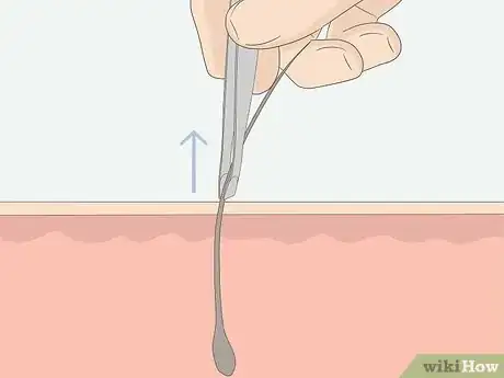 Image intitulée Get Rid of Ingrown Pubic Hair Step 11