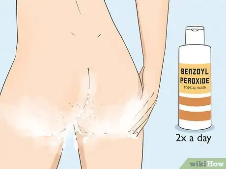 Image intitulée Get Rid of Acne on the Buttocks Step 8