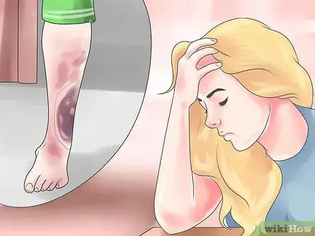 Image intitulée Heal a Hematoma at Home Step 14