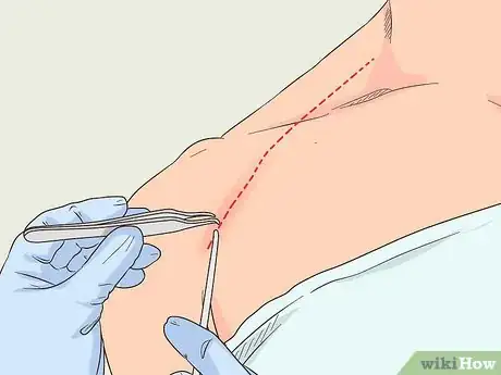 Image intitulée Fix a Pinched Nerve in the Shoulder Step 10