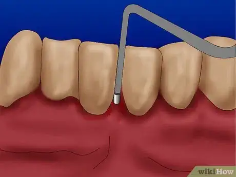 Image intitulée Get Rid of Gingivitis Step 4Bullet1