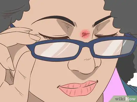 Image intitulée Quickly Heal Open Sores on Your Face Step 10