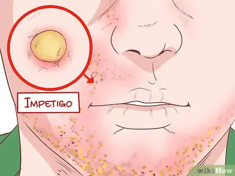 Image intitulée Identify Symptoms of MRSA Step 9