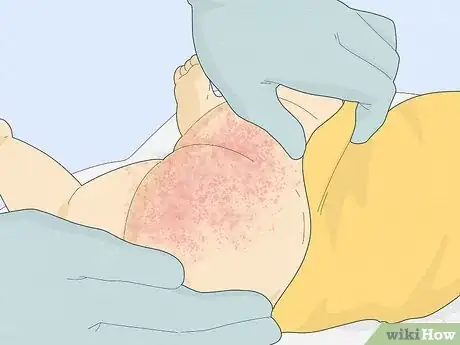 Image intitulée Treat Baby Heat Rash Step 10