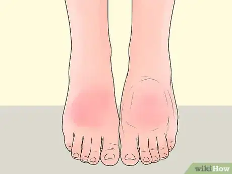 Image intitulée Check Feet for Complications of Diabetes Step 7