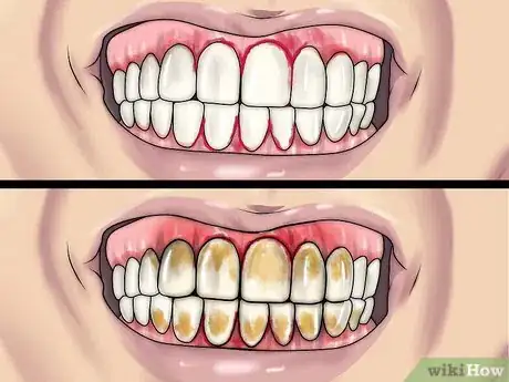 Image intitulée Detect Gum Disease Step 2