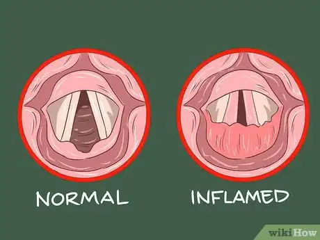 Image intitulée Know if You Have Laryngitis Step 14