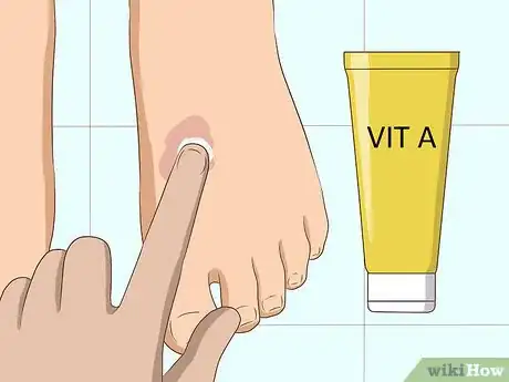 Image intitulée Remove Birthmarks Step 10