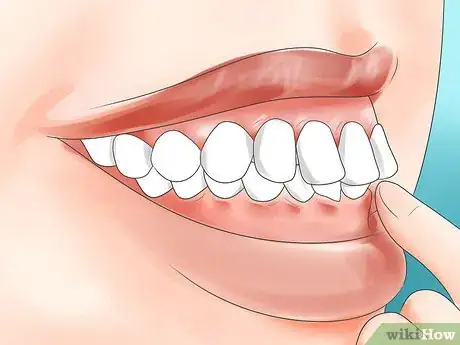 Image intitulée Determine if You Need Braces Step 4