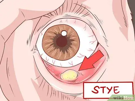 Image intitulée Identify Symptoms of MRSA Step 8