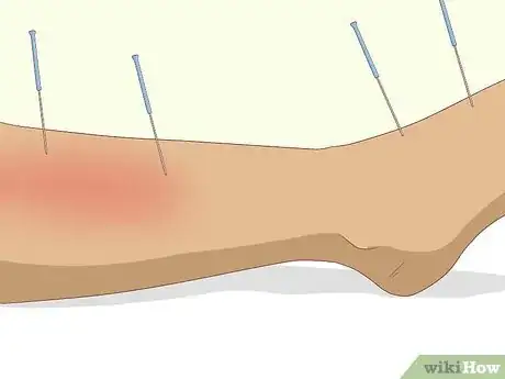 Image intitulée Get Rid of Leg Pain Step 7