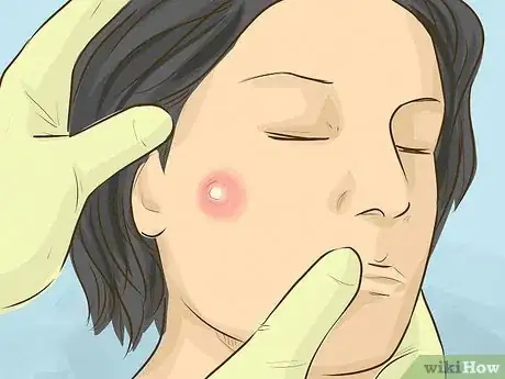 Image intitulée Remove a Cyst on Your Face Step 3