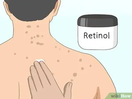 Image intitulée Get Rid of Back Acne Scars Step 3