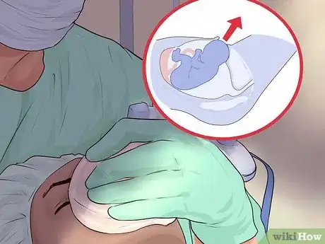 Image intitulée Deal with Placenta Previa Step 16