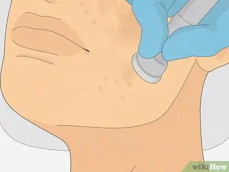 Image intitulée Get Rid of Cystic Acne Scars Step 10