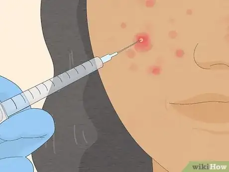 Image intitulée Get Rid of Cystic Acne Scars Step 20