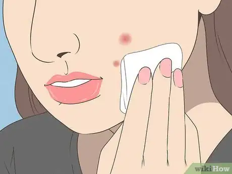 Image intitulée Reduce Pimple Redness and Size (Aspirin Method) Step 5