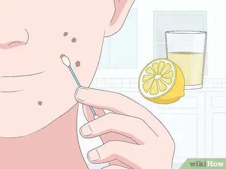 Image intitulée Get Rid of Dark Spots from Acne Step 1