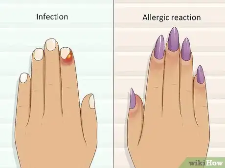 Image intitulée Stop Itchy Cuticles Step 4