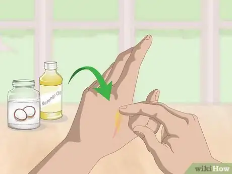 Image intitulée Get Rid of Scars Step 1