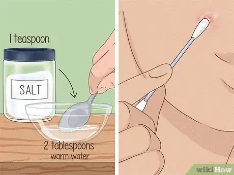 Image intitulée Get Rid of a Zit Overnight Step 1