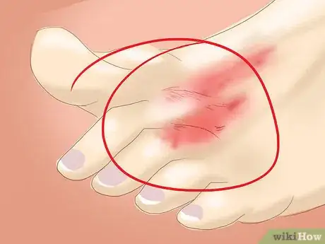 Image intitulée Diagnose Unusually Cold Hands Step 10