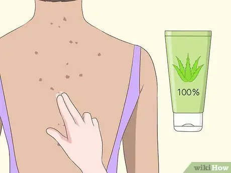 Image intitulée Get Rid of Back Acne Scars Step 9