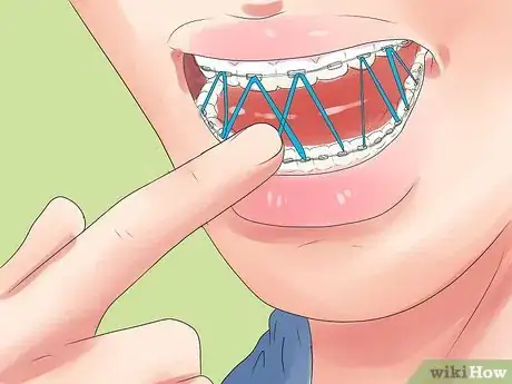 Image intitulée Alleviate Orthodontic Brace Pain Step 11