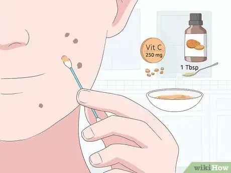 Image intitulée Get Rid of Dark Spots from Acne Step 3