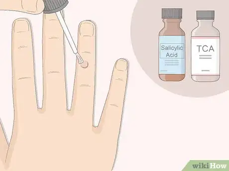 Image intitulée Get Rid of Warts Step 2