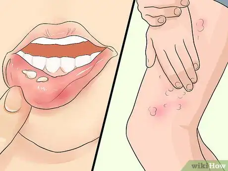 Image intitulée Recognize Herpes Step 5
