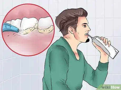 Image intitulée Cure Gingivitis Step 7