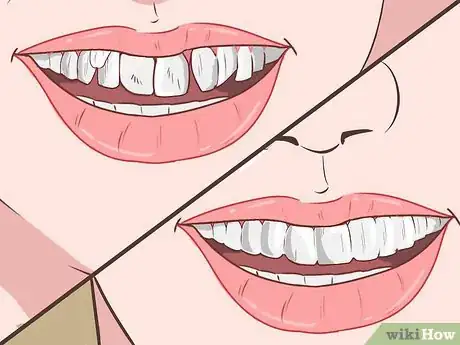 Image intitulée Straighten Your Teeth Without Braces Step 6