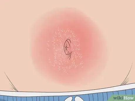 Image intitulée Treat an Infection in Your Belly Button Step 2