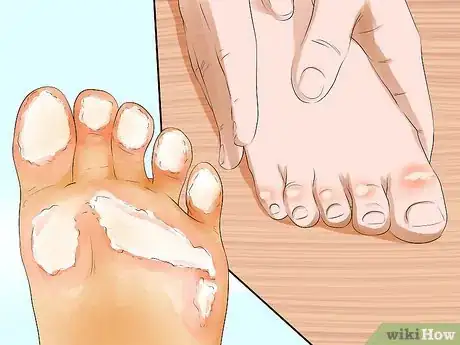 Image intitulée Remove Calluses Naturally Step 2