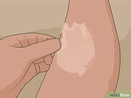 Image intitulée Remove Scars on Legs Step 17