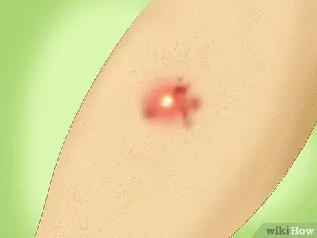 Image intitulée Treat a Staph Infection Step 1