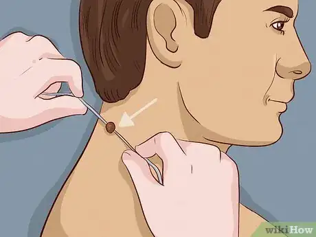 Image intitulée Remove a Skin Tag from Your Neck Step 11